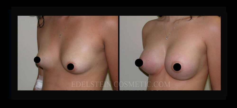 Breast Augmentation case #26776