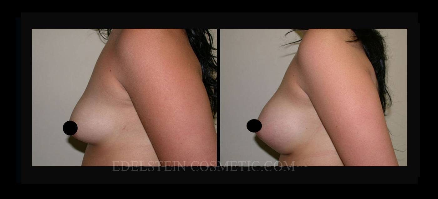 Breast Augmentation case #26776