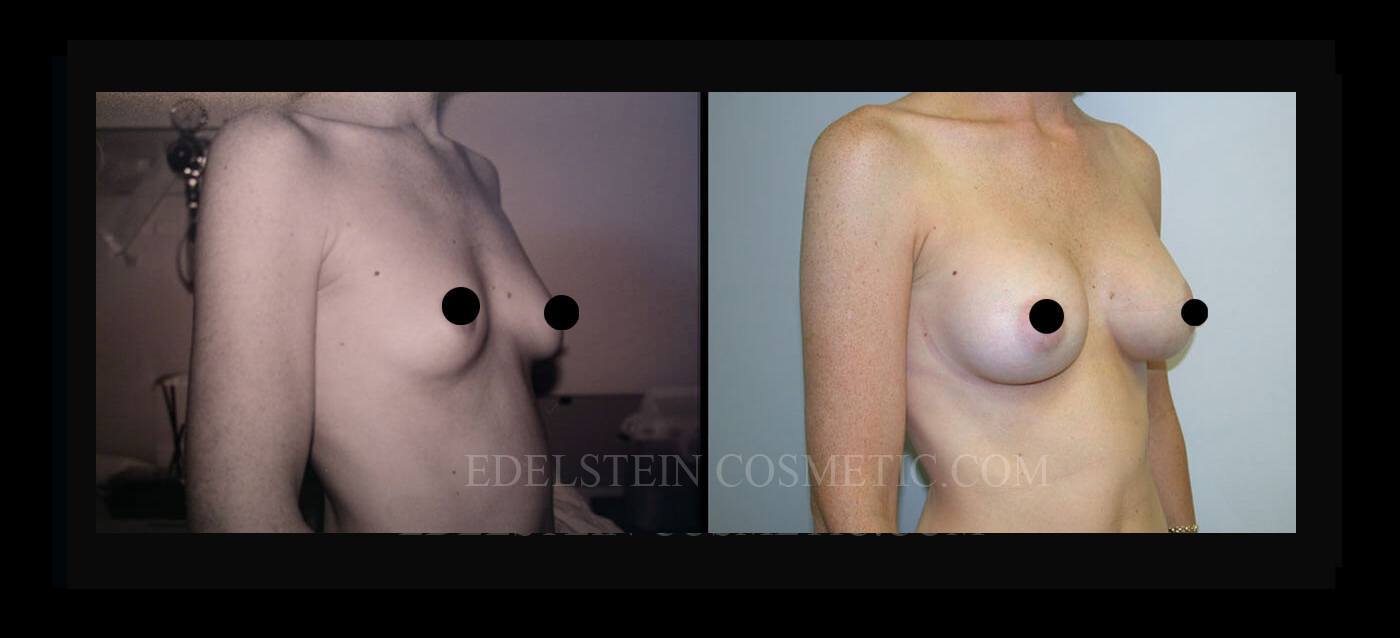 Breast Augmentation case #26774