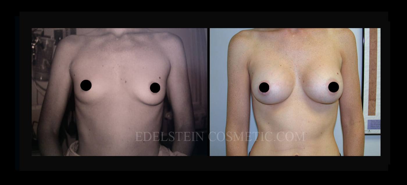 Breast Augmentation case #26774