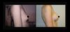 Breast Augmentation case #26774 slider thumbnail