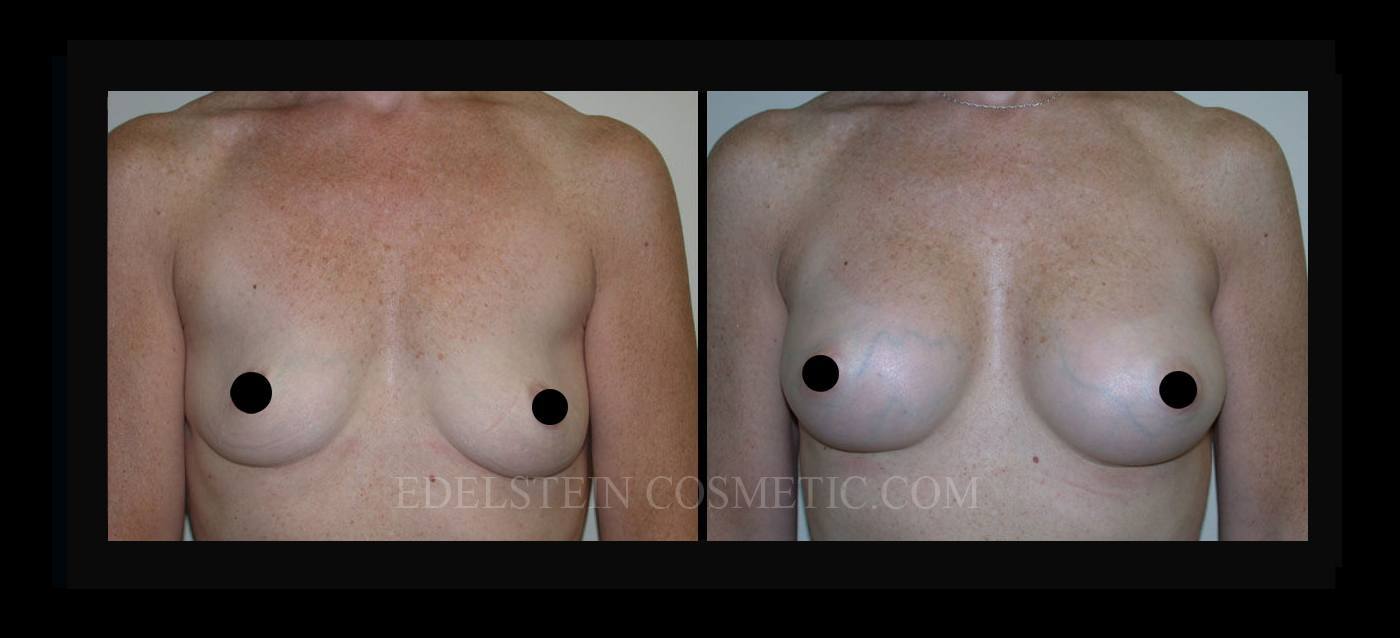 Breast Augmentation case #26772