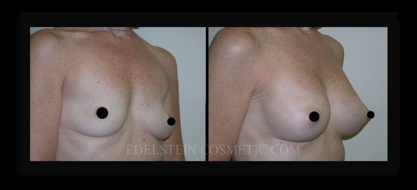 Breast Augmentation case #26772