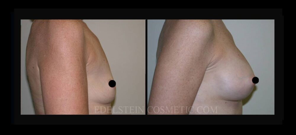 Breast Augmentation case #26772