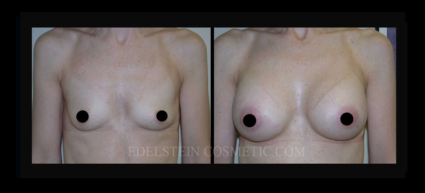 Breast Augmentation case #26766