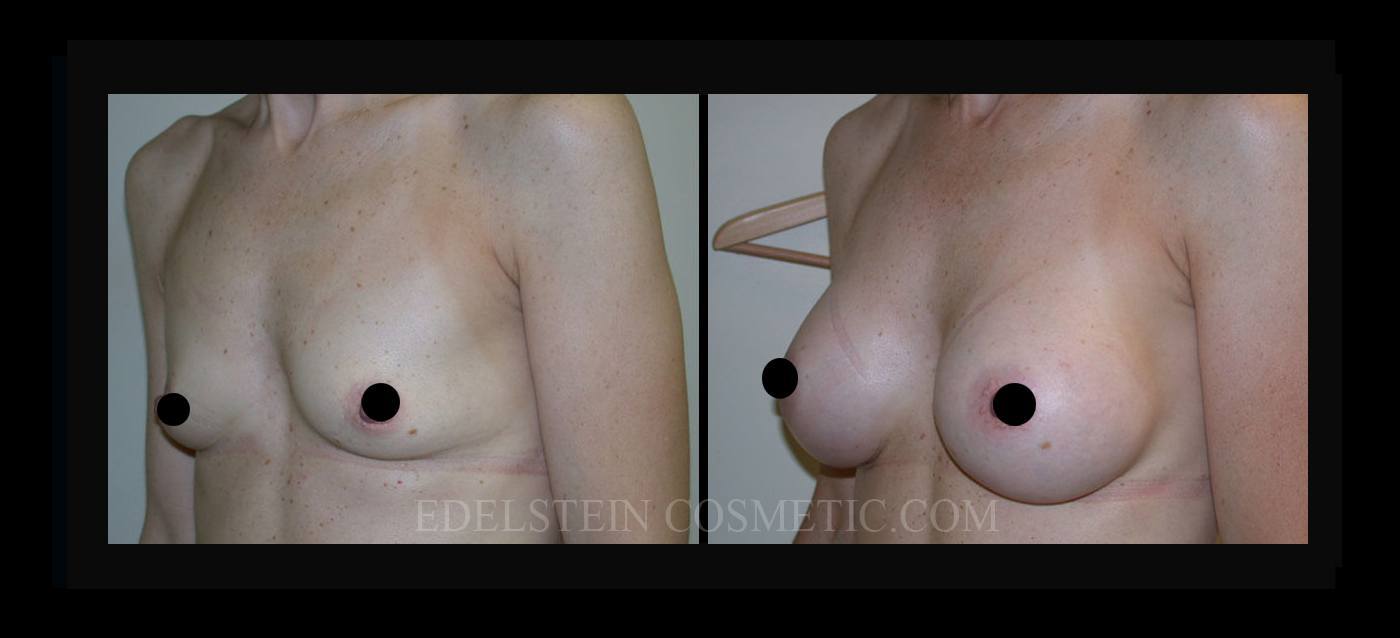 Breast Augmentation case #26766