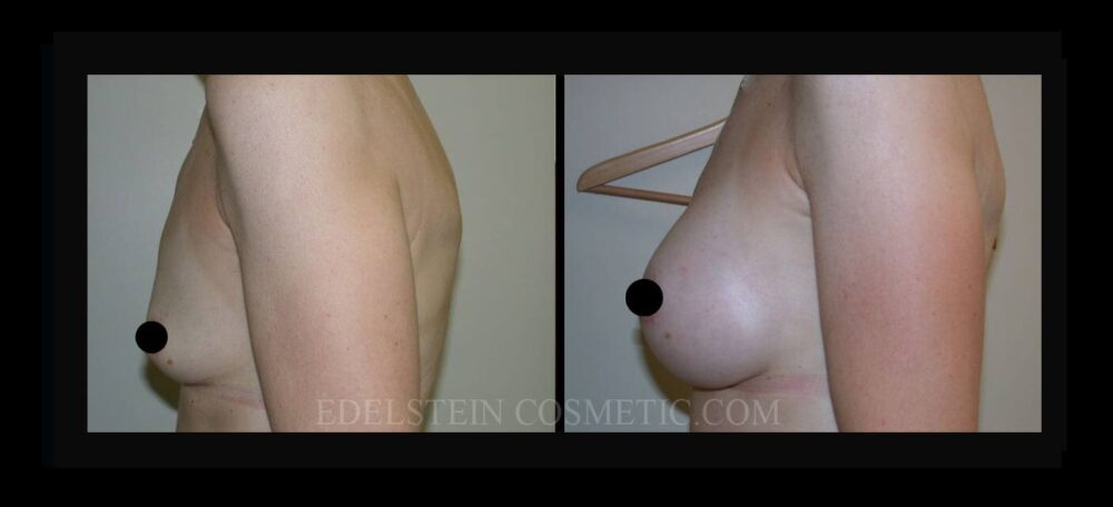 Breast Augmentation case #26766