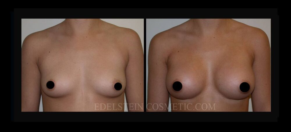 Breast Augmentation case #26764