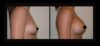 Breast Augmentation case #26764 slider thumbnail