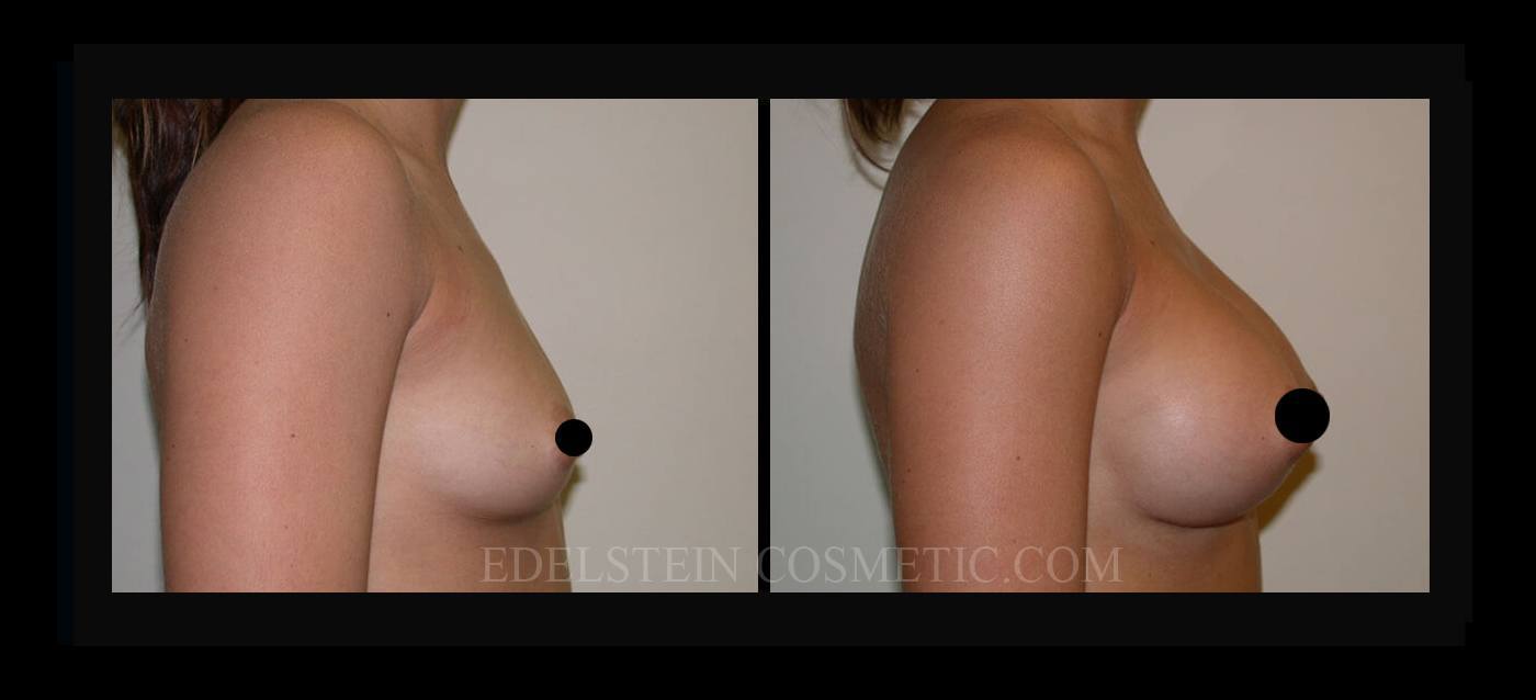 Breast Augmentation case #26764