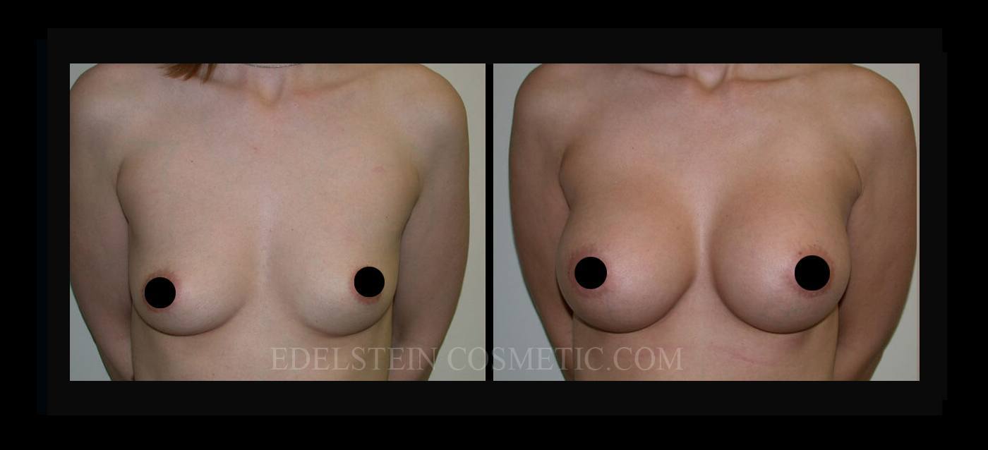 Breast Augmentation case #26763