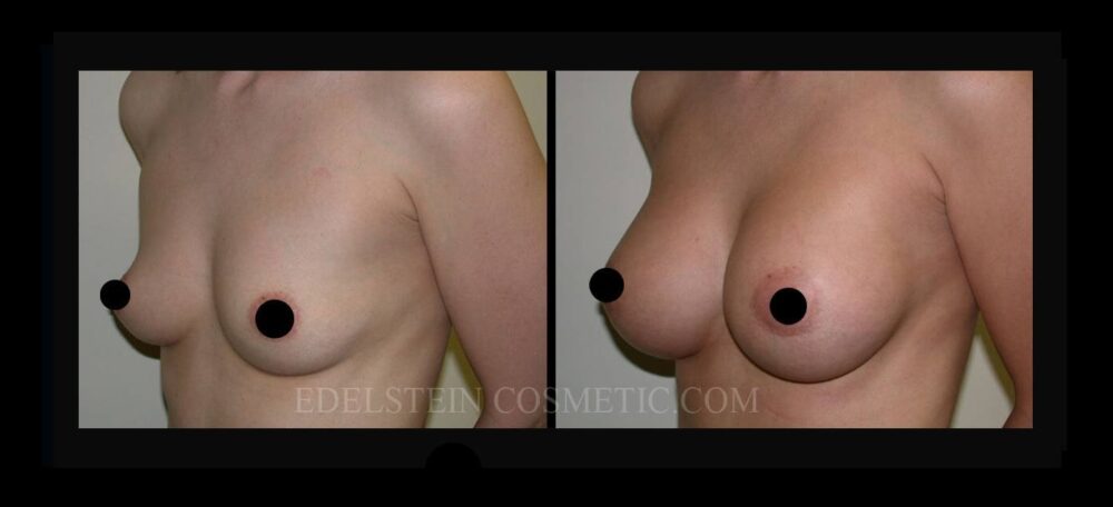 Breast Augmentation case #26763