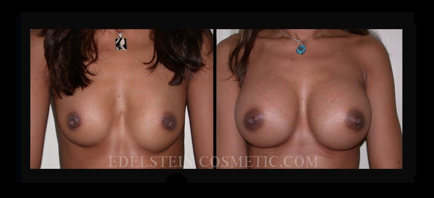 Breast Augmentation case #26762