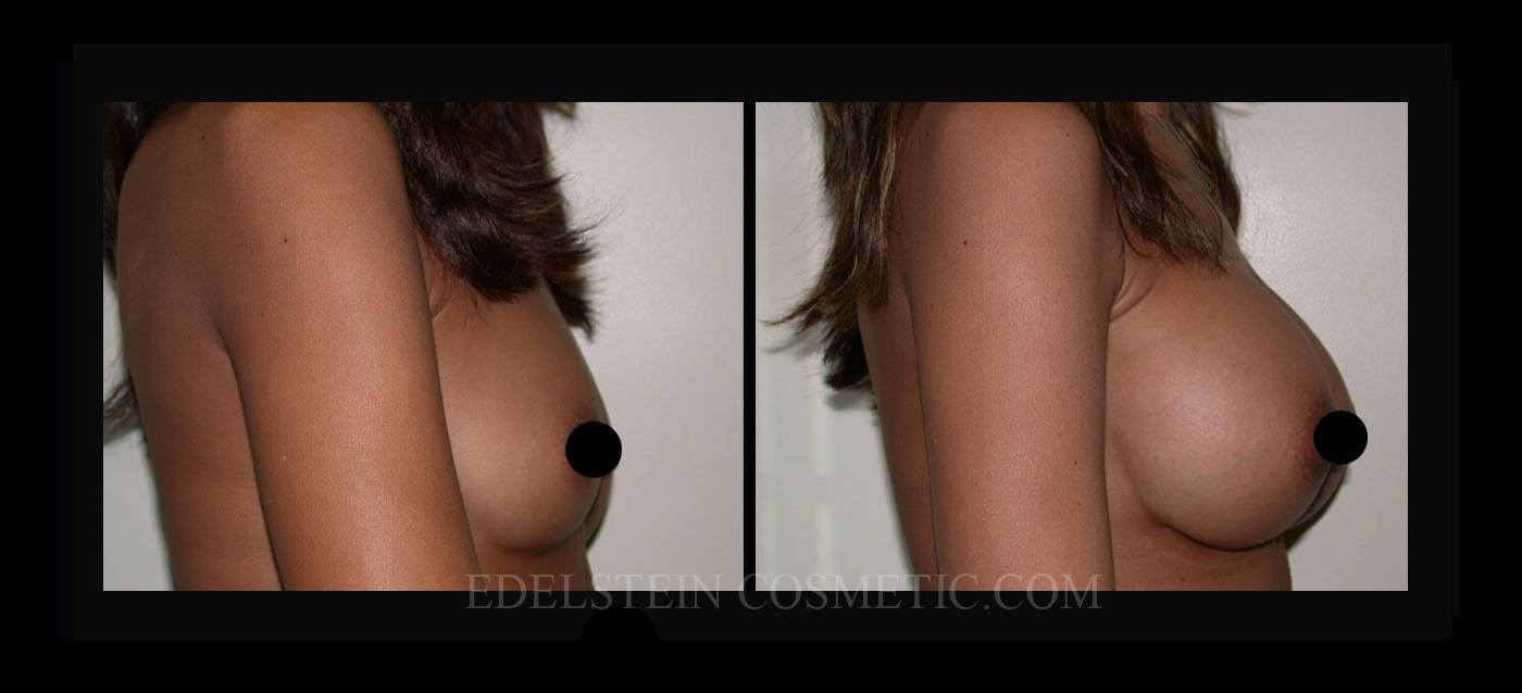 Breast Augmentation case #26762