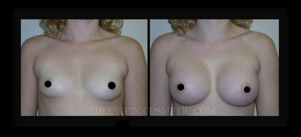 Breast Augmentation case #26761