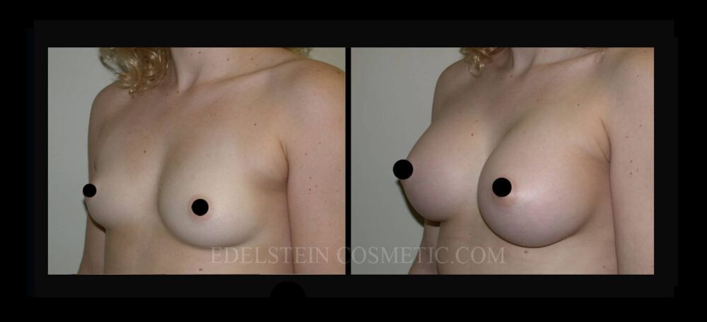 Breast Augmentation case #26761