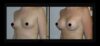 Breast Augmentation case #26760 slider thumbnail