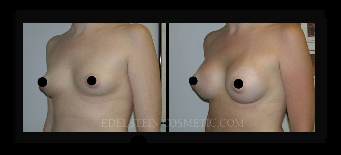Breast Augmentation case #26760