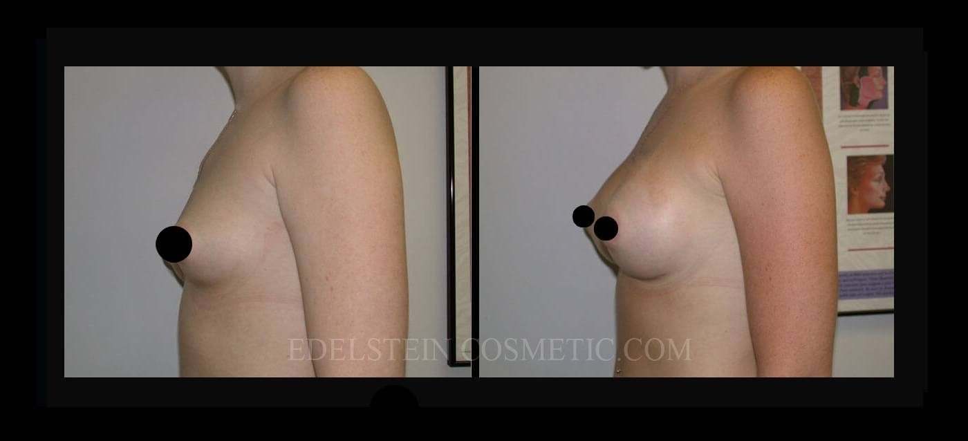 Breast Augmentation case #26760