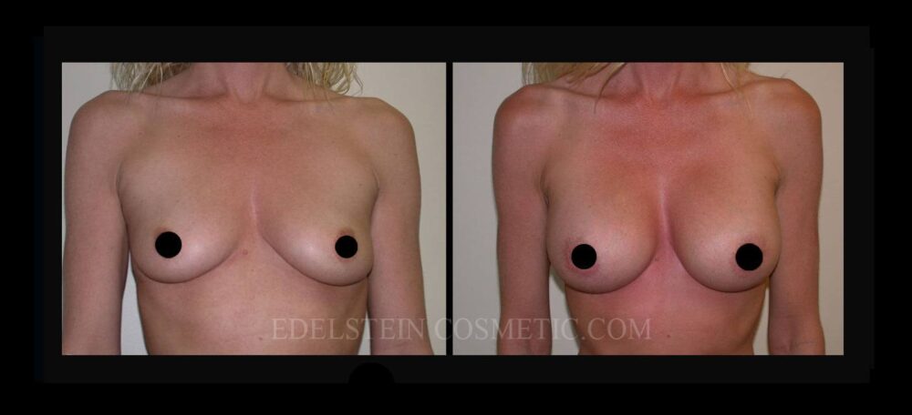 Breast Augmentation case #26759