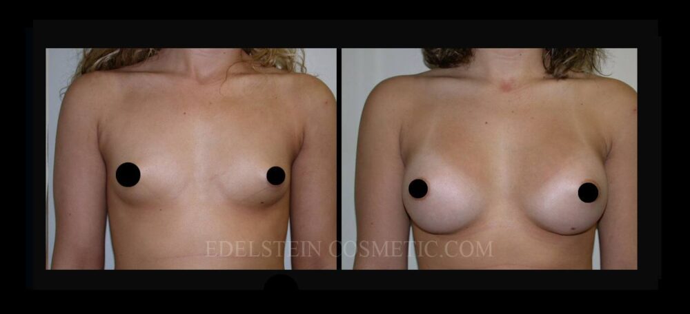 Breast Augmentation case #26758