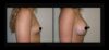 Breast Augmentation case #26758 slider thumbnail