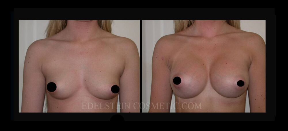 Breast Augmentation case #26757