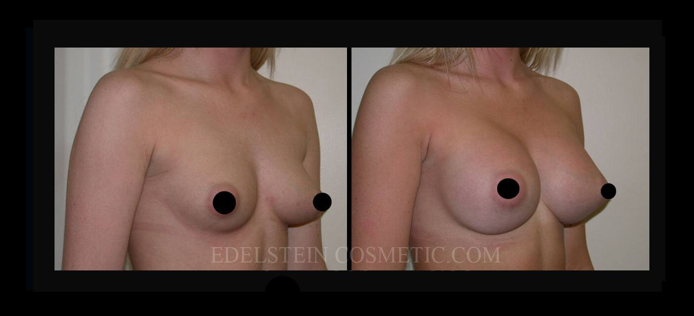 Breast Augmentation case #26757