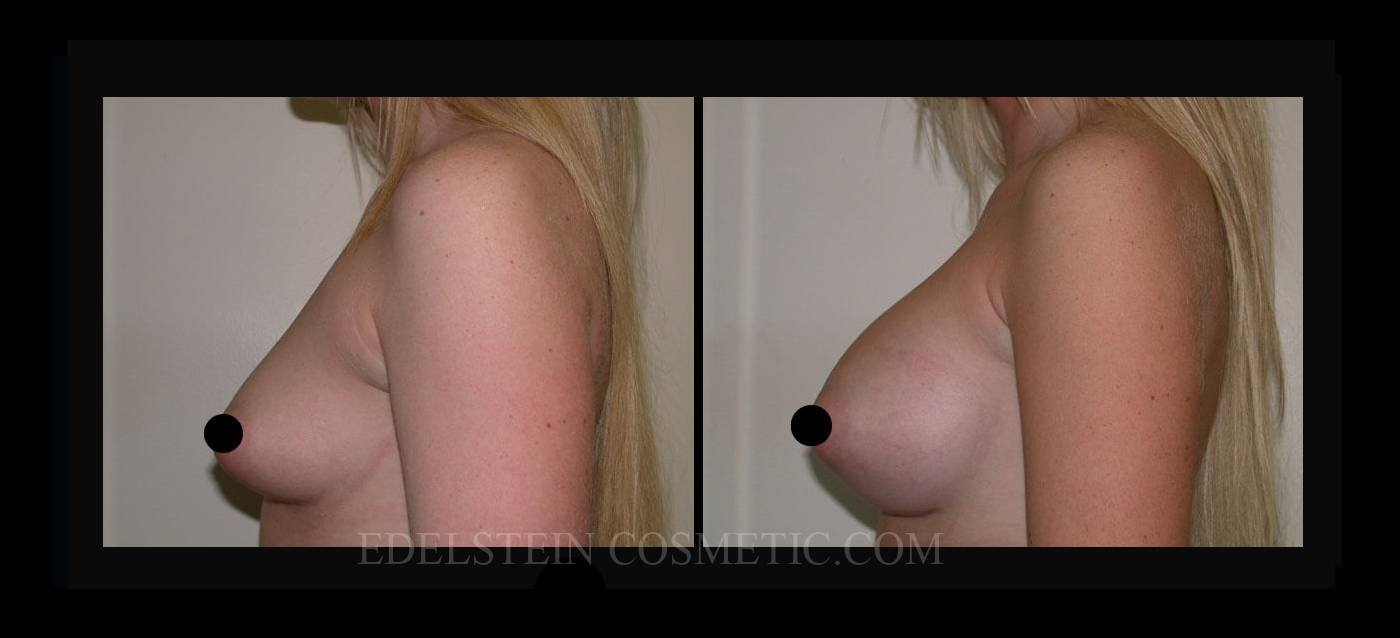 Breast Augmentation case #26757