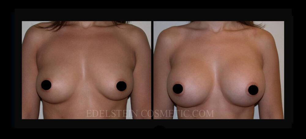 Breast Augmentation case #26745