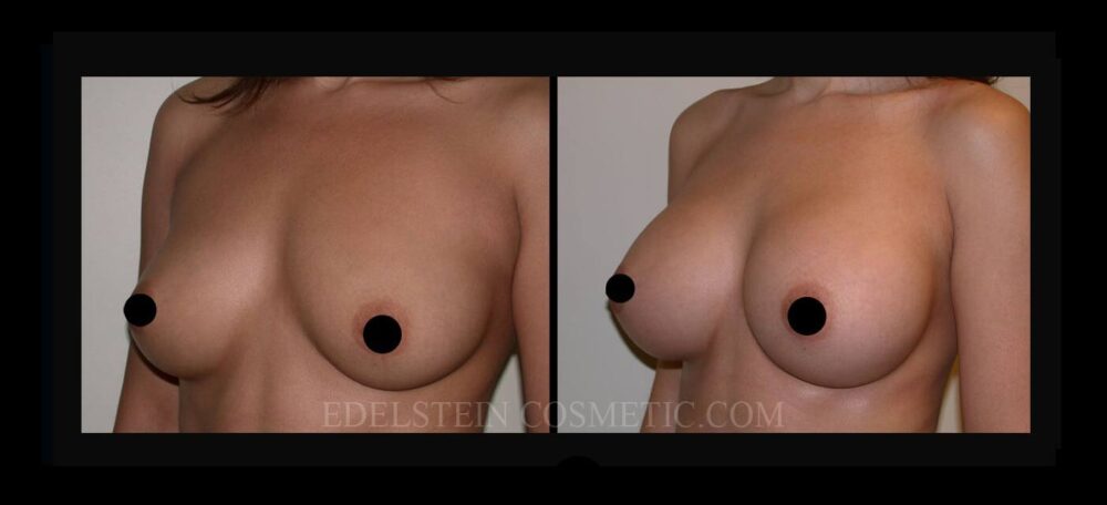 Breast Augmentation case #26745