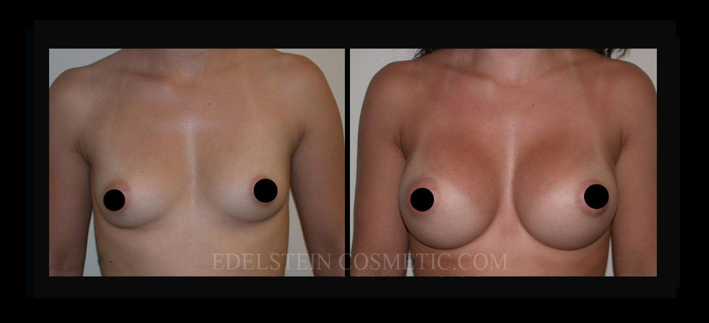 Breast Augmentation case #26740
