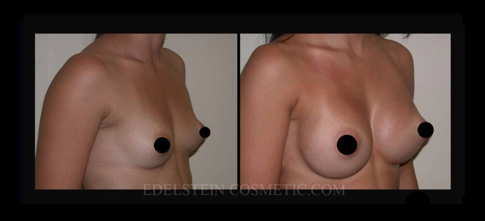 Breast Augmentation case #26740