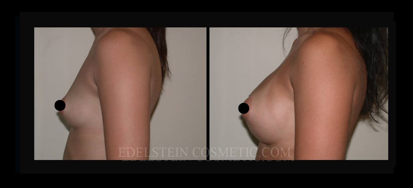 Breast Augmentation case #26740