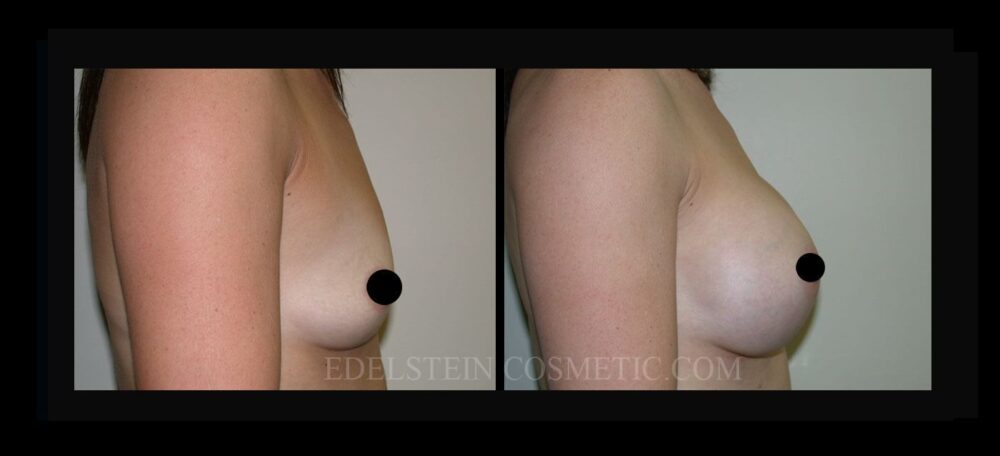 Breast Augmentation case #26738