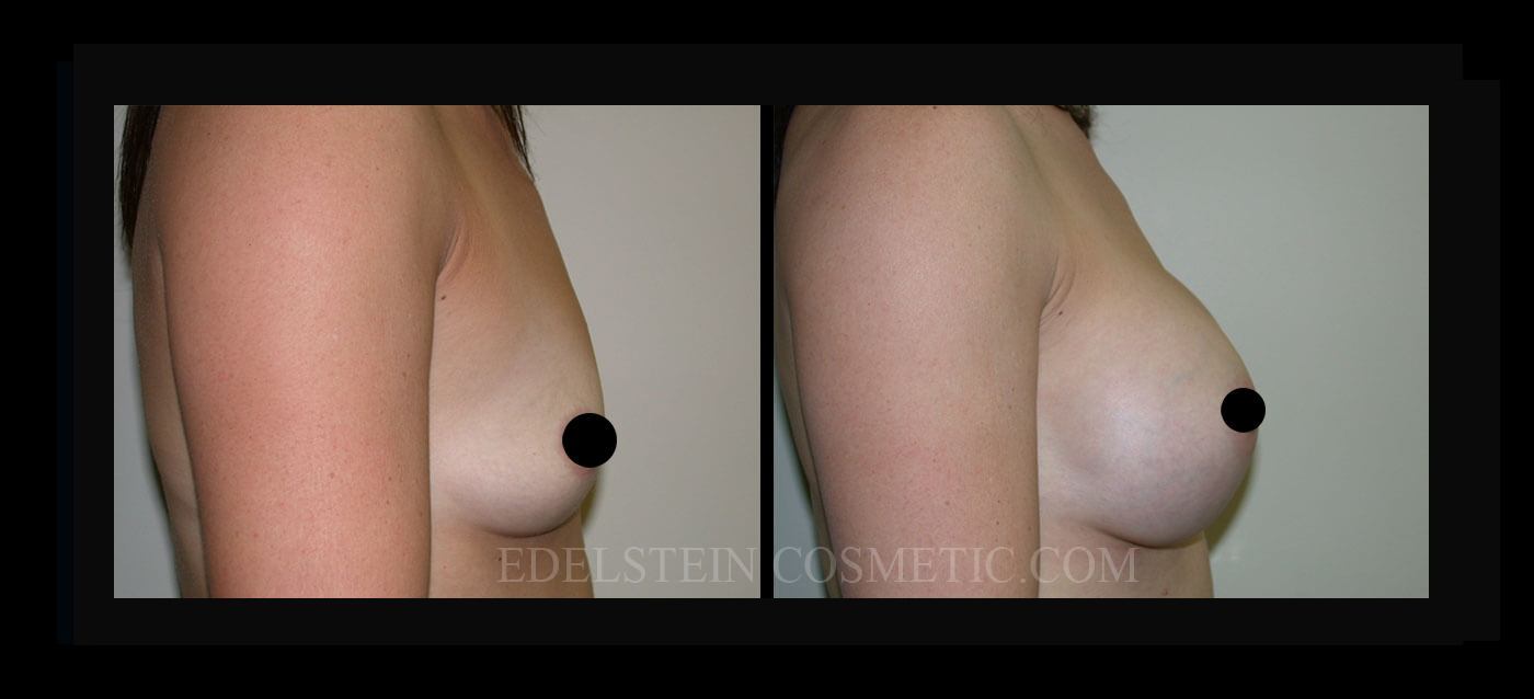 Breast Augmentation case #26738