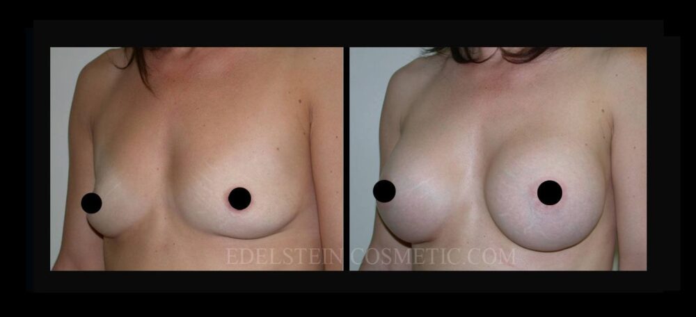 Breast Augmentation case #26738