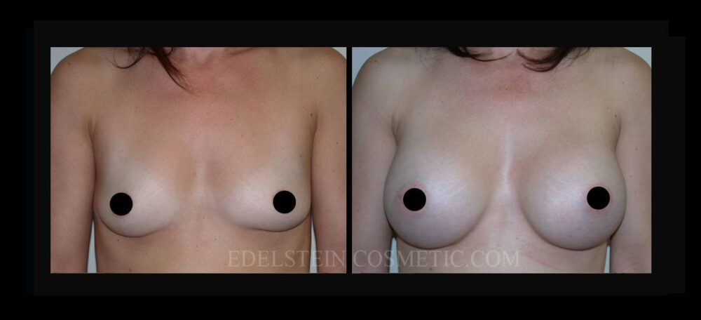 Breast Augmentation case #26738