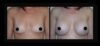 Breast Augmentation case #26738 slider thumbnail