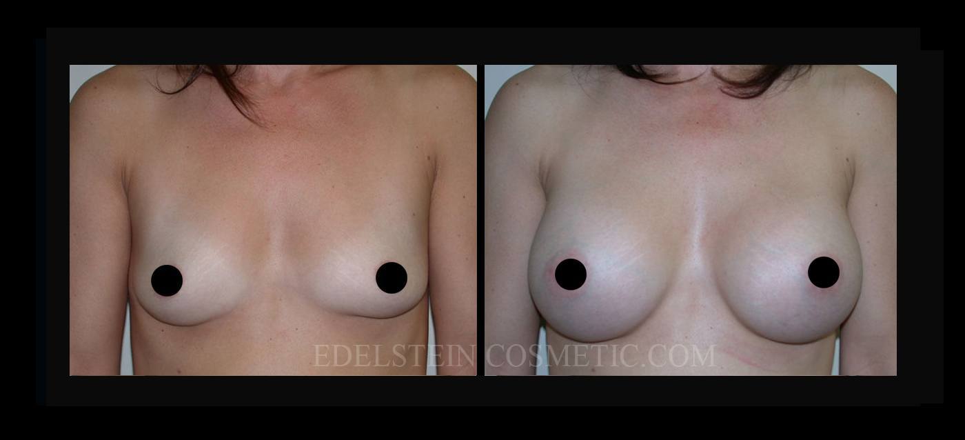 Breast Augmentation case #26738