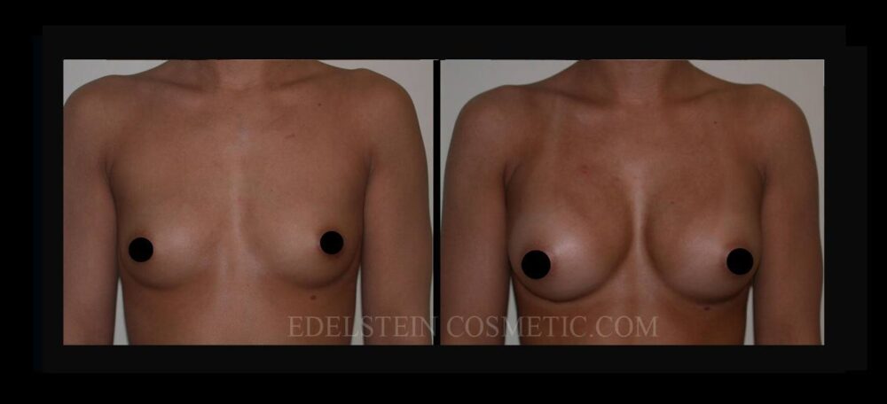 Breast Augmentation case #26737