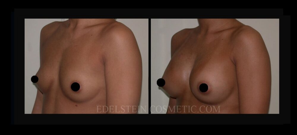 Breast Augmentation case #26737