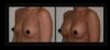 Breast Augmentation case #26737 slider thumbnail