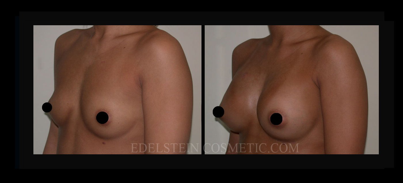 Breast Augmentation case #26737