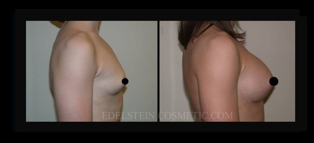 Breast Augmentation case #26734