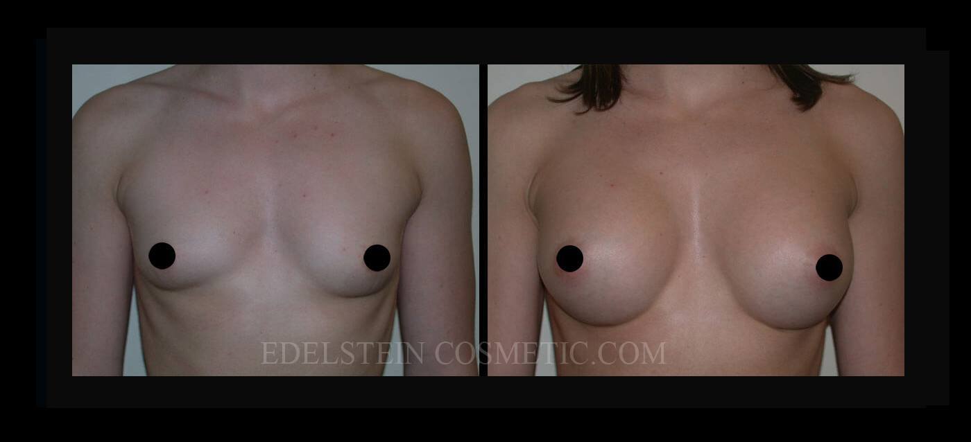 Breast Augmentation case #26734