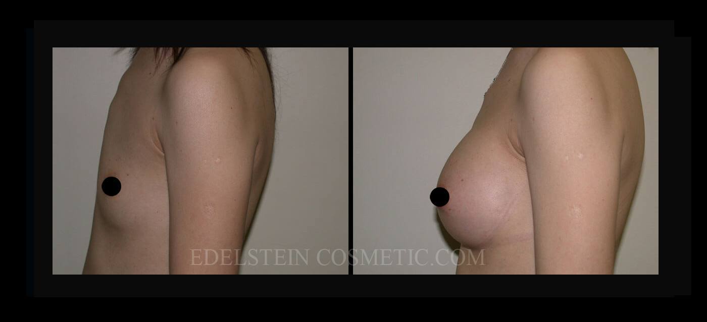 Breast Augmentation case #26732