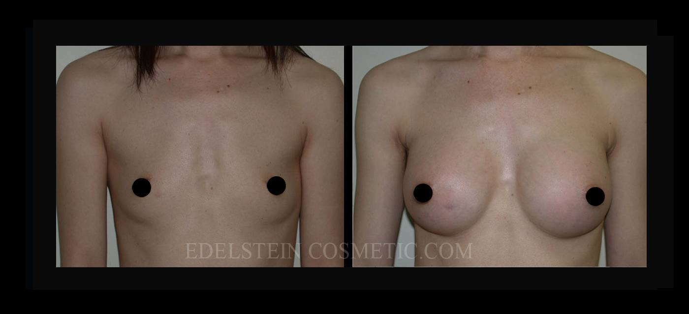 Breast Augmentation case #26732