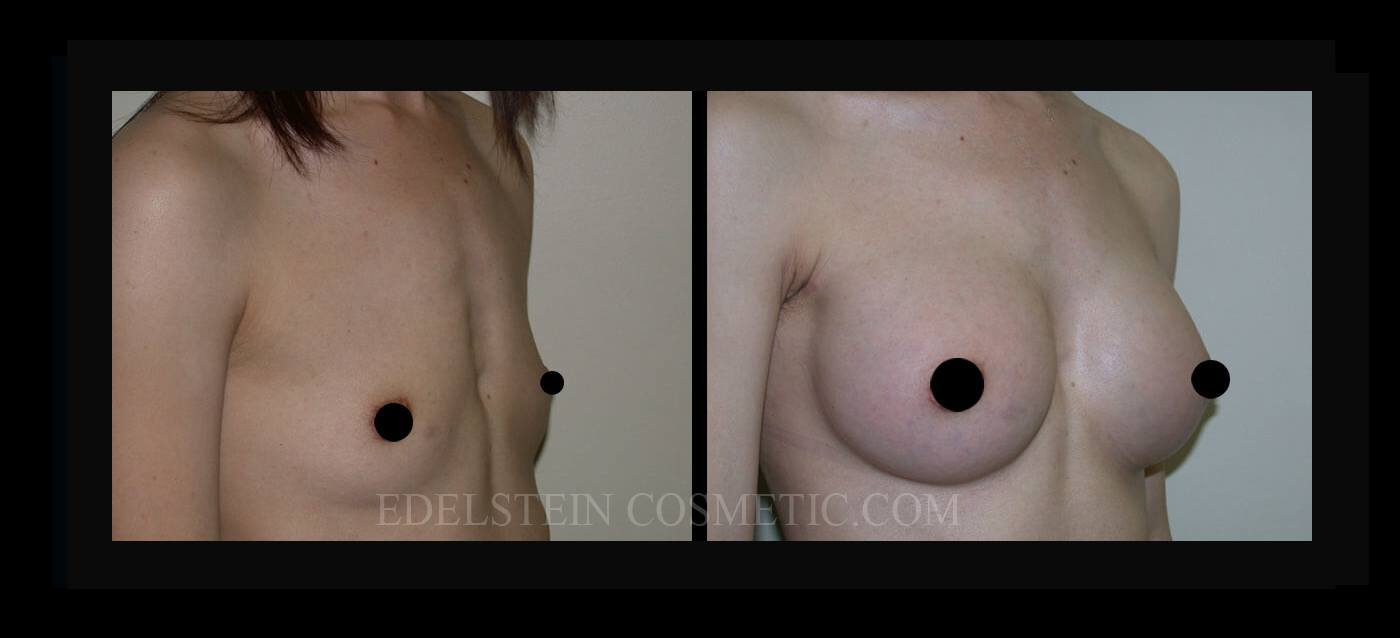 Breast Augmentation case #26732