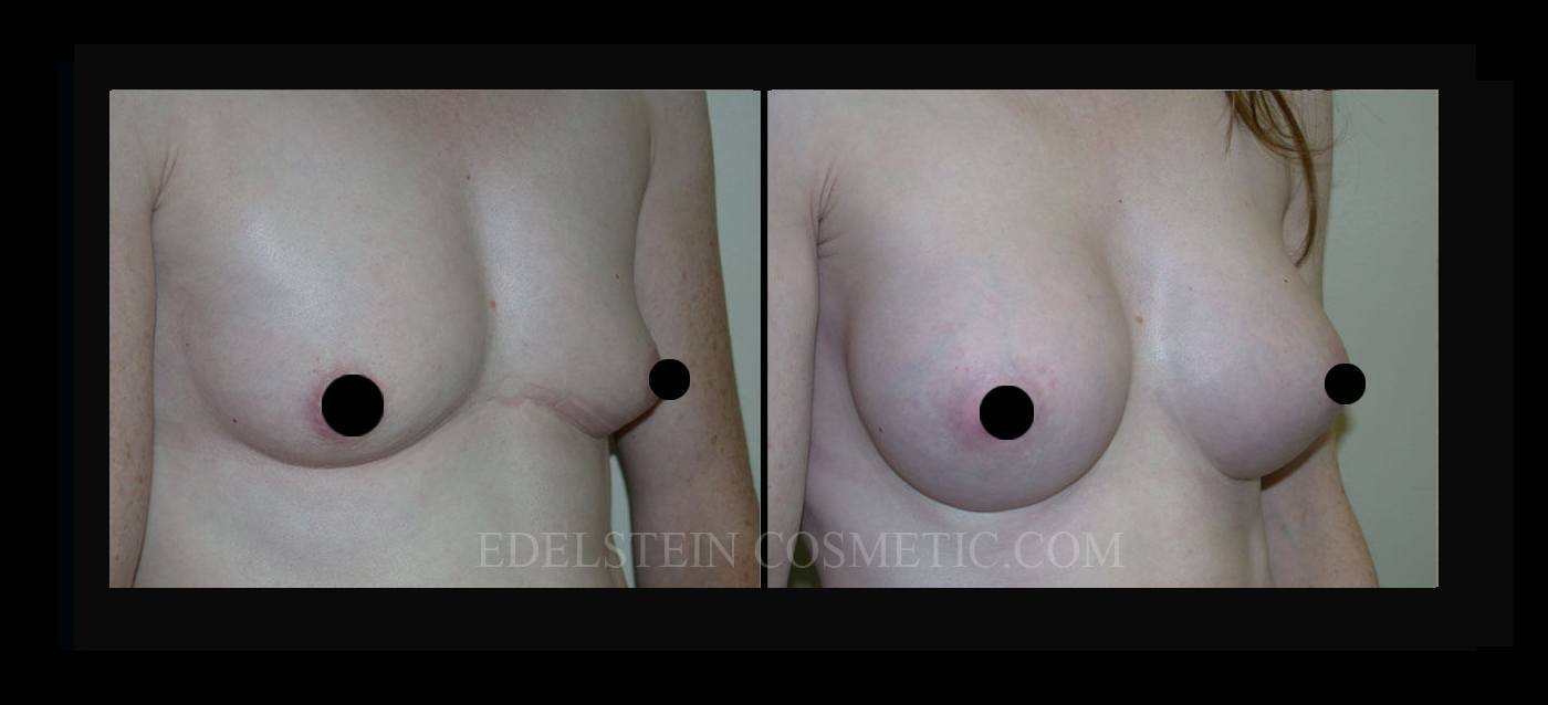 Breast Augmentation case #26731